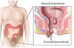 Gastroenterologlar Hemoroid Tedavisi Yapmaktalar