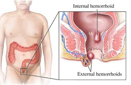 Gastroentereloglar Hemoroid Tedavisi Yapmaktalar