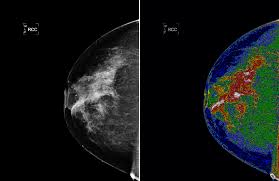 Mamogramların Gösterdiği 3 Yapı