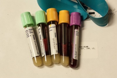 Meme Kanseri Kan İşaretleyici Testleri