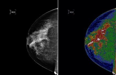 Doktorlar Mamogramları Nasıl Yorumluyor?