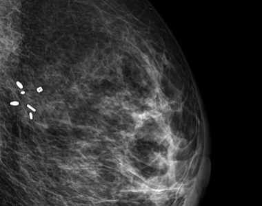 Farklı Meme Cerrahisi Sonrası Mamogramlar