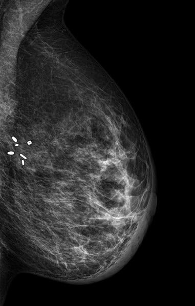 Farklı Meme Cerrahisi Sonrası Mamogramlar