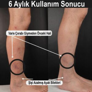 Kompresyon çorapları, ayak bileğinden bacağa kadar kademeli miktarda basınç uygulayan ve kanın kalbe geri akışını hızlandıran, elastikten yapılmış çoraplardır.