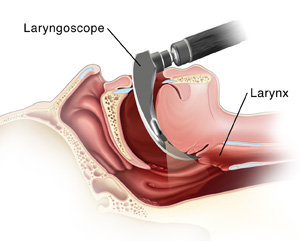Laringoskop, ışık takılı sert, içi boş bir tüptür. Sağlık uzmanınız bu aracı kullanarak dilinizin arkasına ve boğazınızdan ses tellerinize kadar bakabilir.