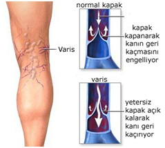 Genellikle bacaklarda görülen cildin hemen altındaki toplardamar genişlemelerine varis adı verilir.