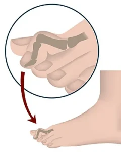 Çekiç parmak tedavisi, parmaktaki deformasyonun düzeyine göre belirlenir. Çekiç parmak probleminin erken evrede fark edilmesi durumunda, cerrahi dışı yöntemlerle sorun düzeltilebilir. 
