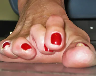 Çekiç parmak, el veya ayak parmaklarının istemsizce kıvrılması ile karakterize edilen bir durumdur. Bu deformite, parmağın bir çekiç şeklini alması ve ağrıya neden olmasıyla tanınır.