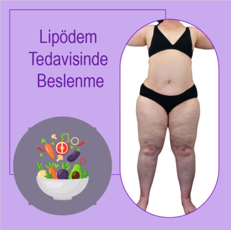 Lipödem Tedavisinde Beslenme